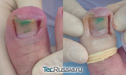 фото до и сразу после лазерного удаления вросшего ногтя