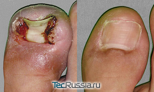 сложный случай удаления вросшего ногтя – до и после операции