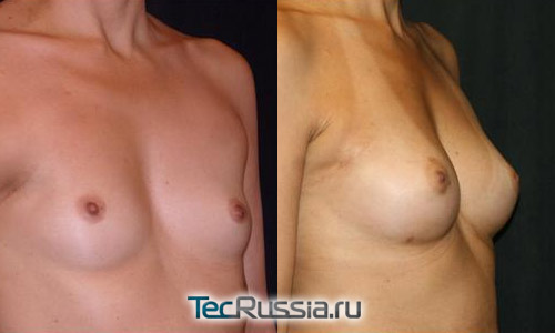 увеличение груди собственным жиром, фото до и после