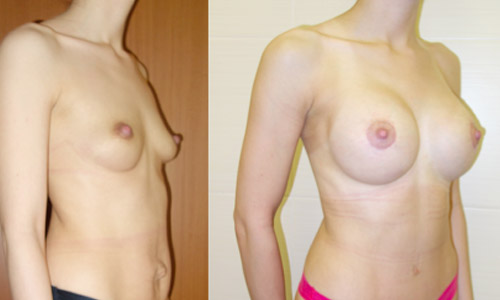 абдоминопластика с подтяжкой груди, фото до и после