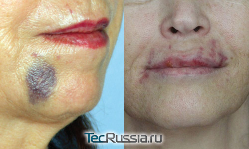 синяки на лице и на губах после введения филлеров гиалуроновой кислоты