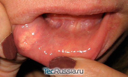 гранулема на нижней губе после инъекций гиалуроновой кислоты