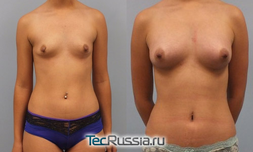 увеличение маленькой груди собственным жиром, фото до и после