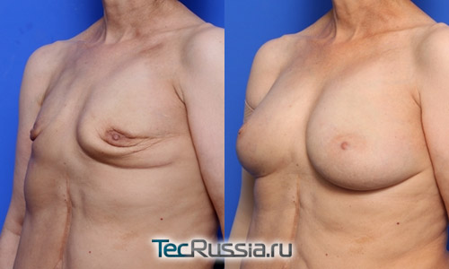 результат восстановления груди собственным жиром после удаления
