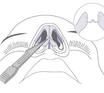 открытая ринопластика