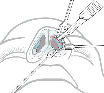 закрытая ринопластика