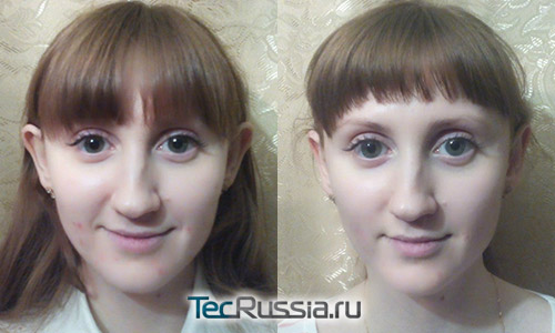 фото до и после использования ушных корректоров у ребенка