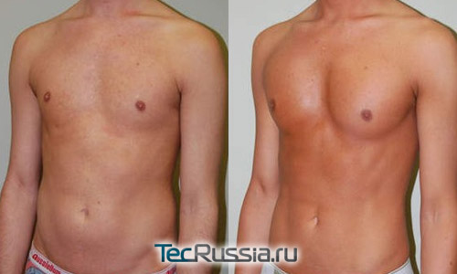 фото до и после коррекции грудных мышц Макролайном