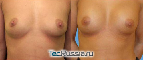 фото до и после увеличения груди Макролайном, вид спереди