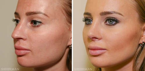 фото до и после пластики носа, вид в три четверти