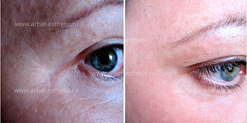 морщины вокруг глаз до и после A-Esthetic