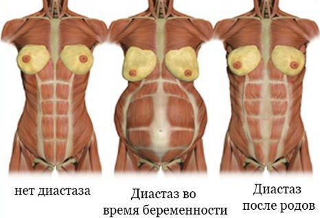 степени диастаза во время и после беременности