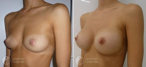 фото до и после пластики груди, Хирург Сергеев И.В.