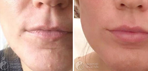 омоложение и увеличение губ (до 50 лет)