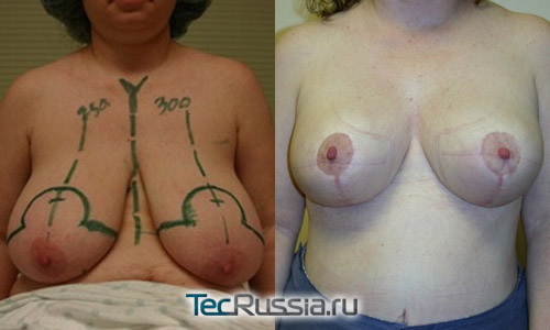 уменьшение и подтяжка груди, фото до и после