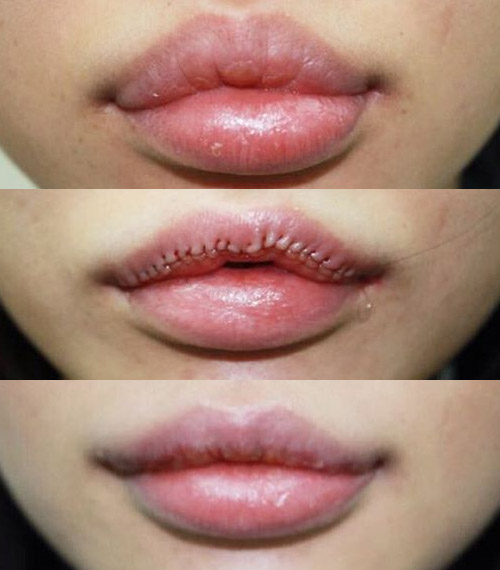 результат удаления филлера из губ, внешний вид шрама
