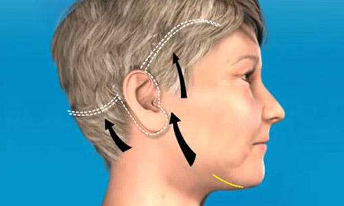 так расположены швы при подтяжке лица