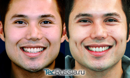 ямочки на щеках у мужчины – до и после операции
