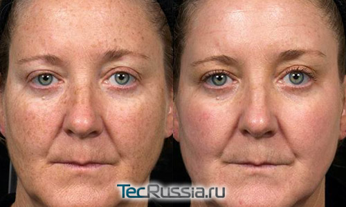 фото до и после лазерного пилинга пигментных пятен на лице