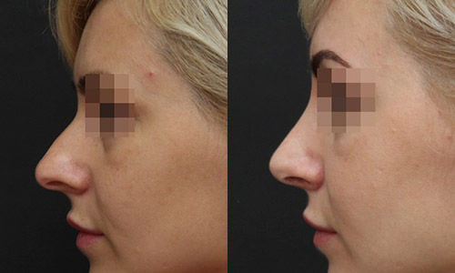 фото до и после ринопластики (хирург – В.С.Григорянц), профиль