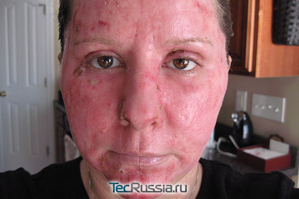 кожа лица через 1 неделю после глубокого лазерного пилинга
