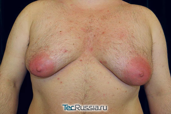 крайняя степень гипертрофии мужских грудных желез