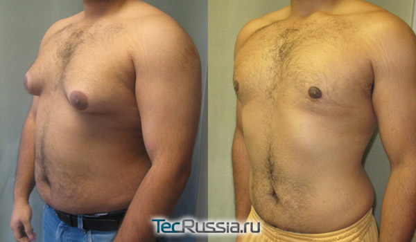 фото до и после операции при гинекомастии, вид сбоку
