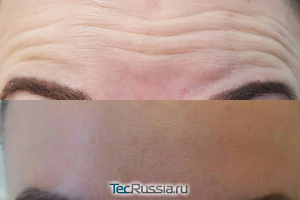 фото до и после разглаживания морщин на лбу с помощью Ботулакса