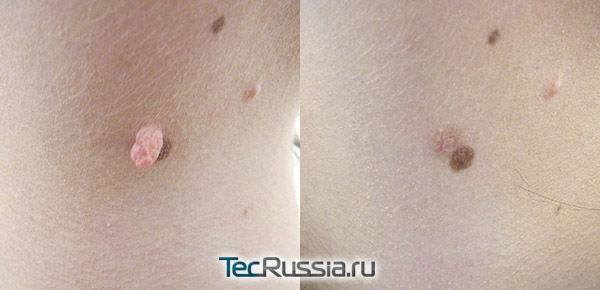 фото до и после удаления папилломы с кожи шеи