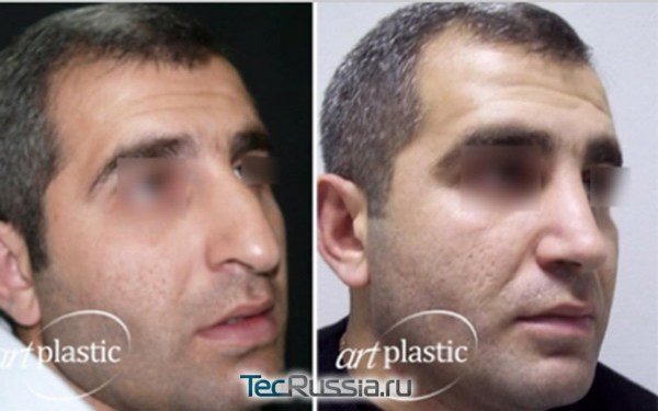 повторная ринопластика кавказского носа