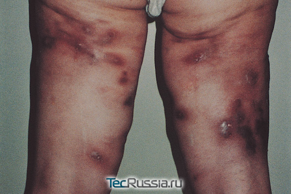 воспаление с некрозом кожи после операции на бедрах