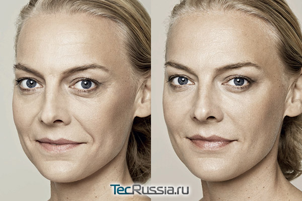 биоревитализация лица, фото до и после
