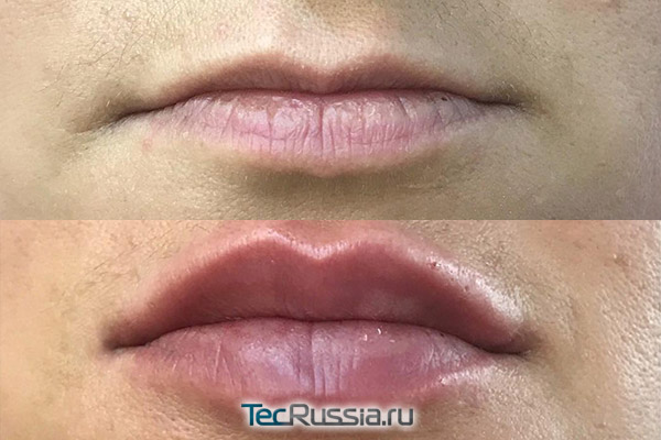 Volume увеличение губ, фото до и после