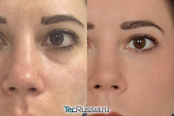 Фото до и после уколов Teosyal под глазами