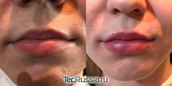 Фото до и после контурной пластики губ препаратом Kiss