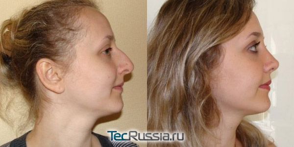 фото до и после пластики носа, хирург – Г.П.Бабаян