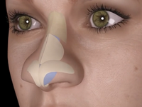 Как исправить кончик носа? Ринопластика для тех, у кого «нос картошкой»
