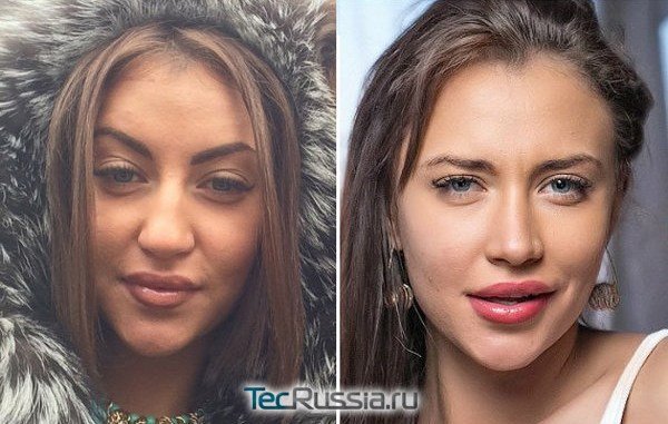 Виктория Берникова до и после ринопластики