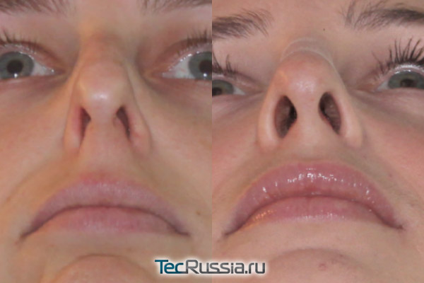 хирургическое расширение носовых ходов, фото до и после операции