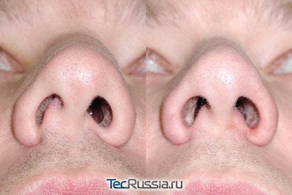 до и после хирургической коррекции перегородки носа