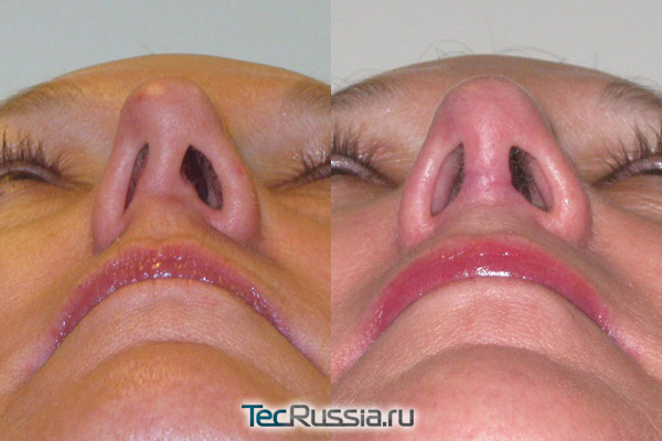 фото до и после септопластики носа