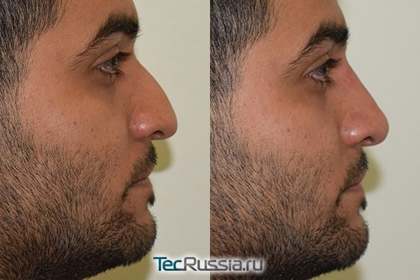 ринопластика с поднятием кончика носа, фото до и после