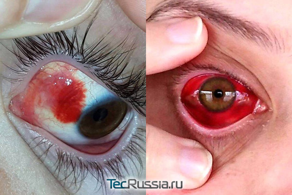 кровоизлияние на роговицу глаза как осложнение после блефаропластики