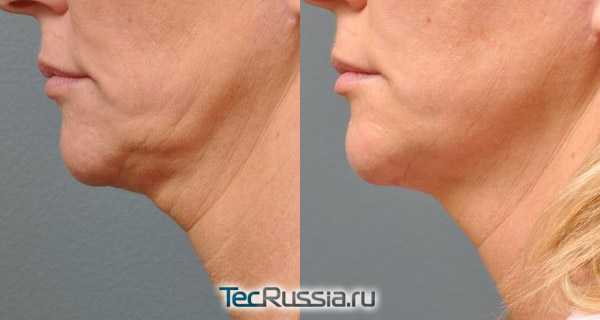 фото до и после Альтера-терапии кожи на шее