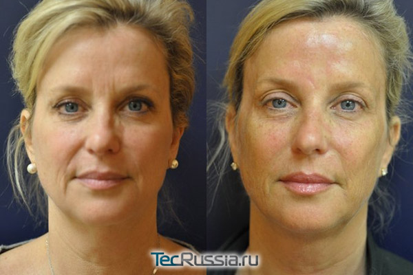 глубокая подтяжка лица на аппарате Ulthera – фото до и после