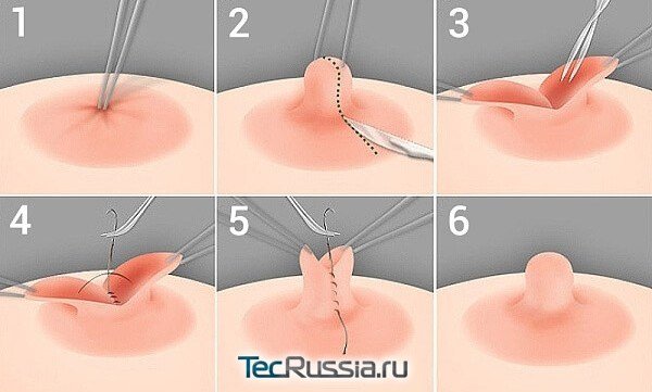 хирургическая коррекция сосков