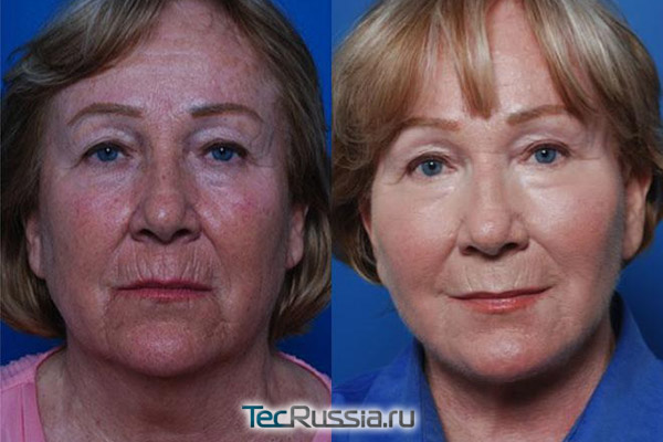 эндоскопическая подтяжка лица, фото до и после операции