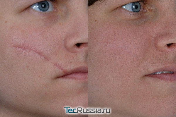 Коррекция рубца на лице - фото до и после
