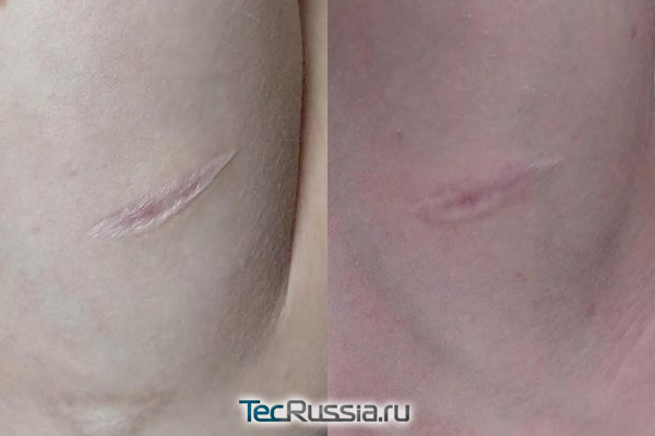 до и после лечения шрама