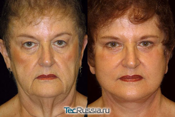 фото до и после подтяжки и пилинга лица